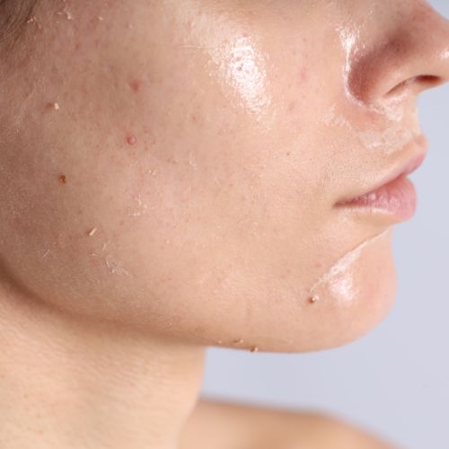 Hydra Facial in Mumbai